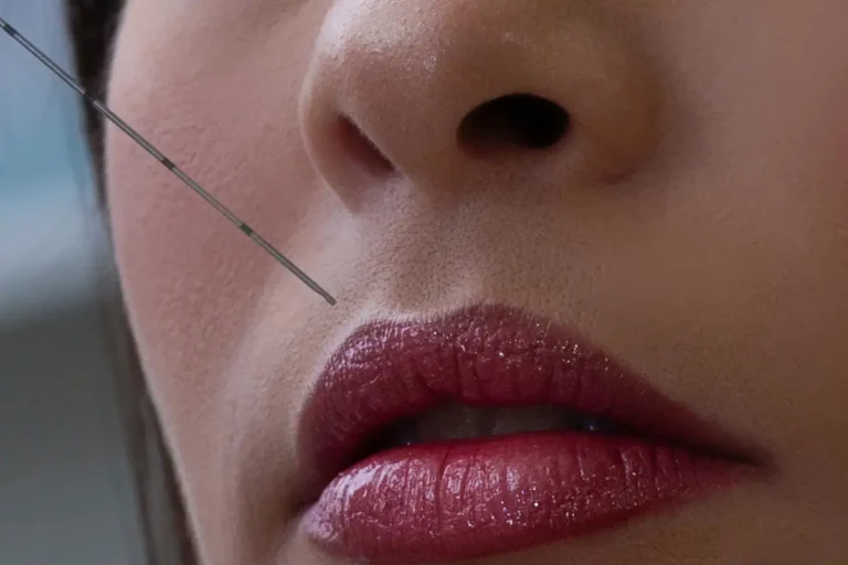 Close-up of a woman's lower face with full, glossy red lips as a thin needle is positioned near the upper lip for a cosmetic filler injection procedure.